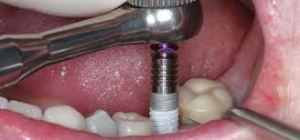 Dental Implantology Courses in India| Dental Implant Courses